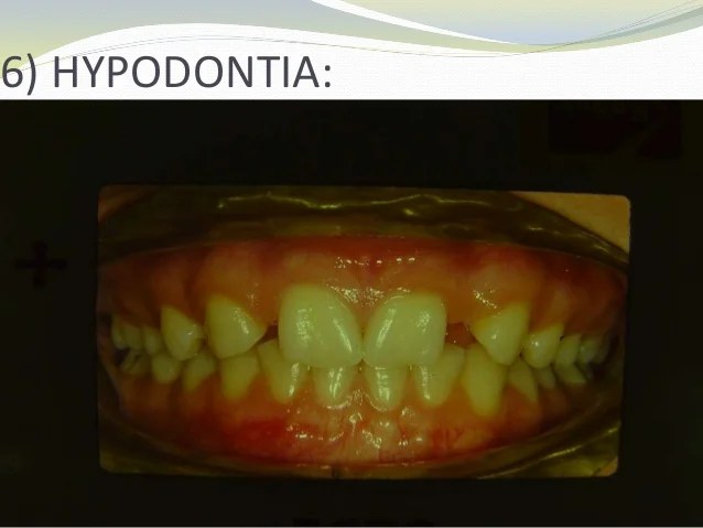 Unveiling Neanderthal Canine Diastema: A Dental Mystery Explored