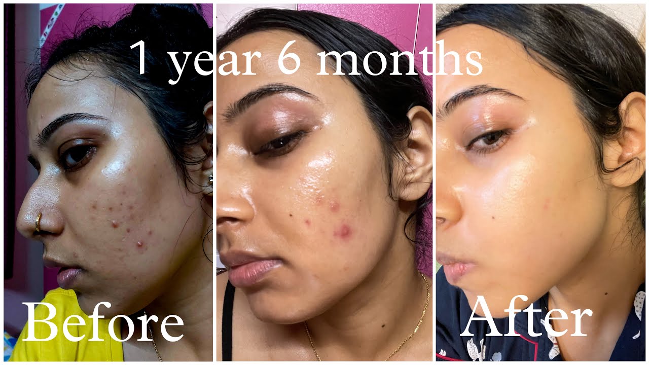 Tretinoin Cream Before and After: Transform Your Skin Fast